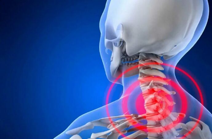 Osteocondrosi della colonna cervicale