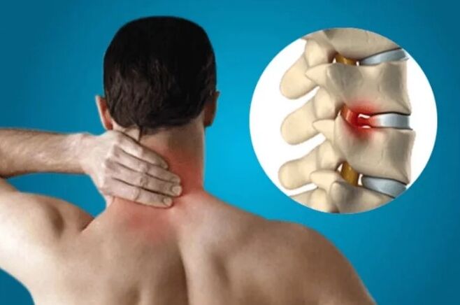 Osteocondrosi della colonna vertebrale