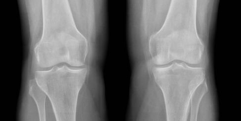 artrosi del ginocchio alla radiografia